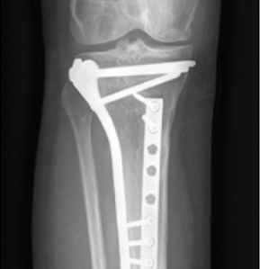 Imatge osteosíntesi tíbia