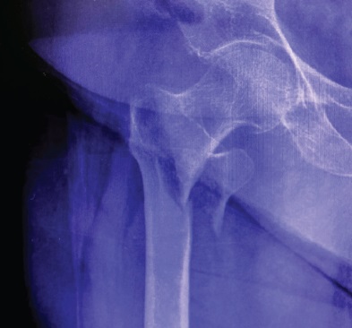 radiografia fractura proximal fèmur