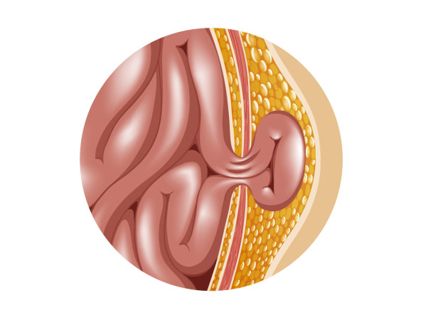 Dibujo de una hernia