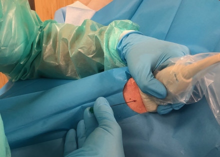 REalització d'una tècnica a càrrec de l'Equip d'Accés Vascular