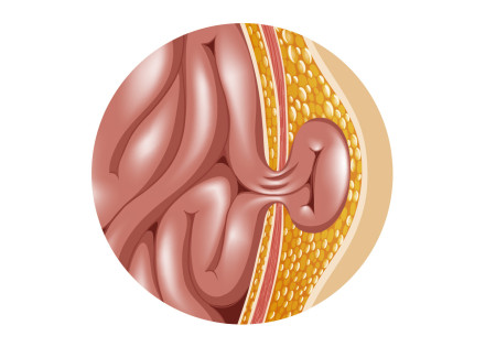 Dibujo de una hernia