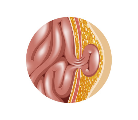 Dibujo de una hernia